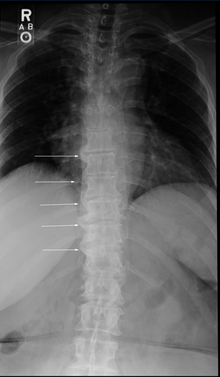 Diffuse Idiopathic Skeletal Hyperostosis (DISH) Quiz Cross Border